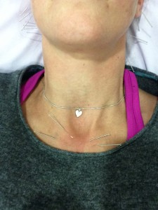 Dry Needling neck and face